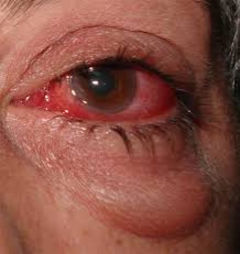 Manejo de la queratoconjuntivitis vernal severa refractaria en la infancia