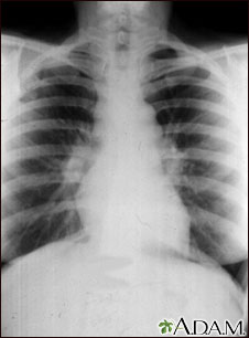 sarcoidosis