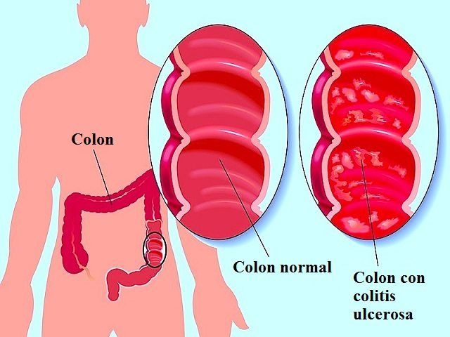 colitis